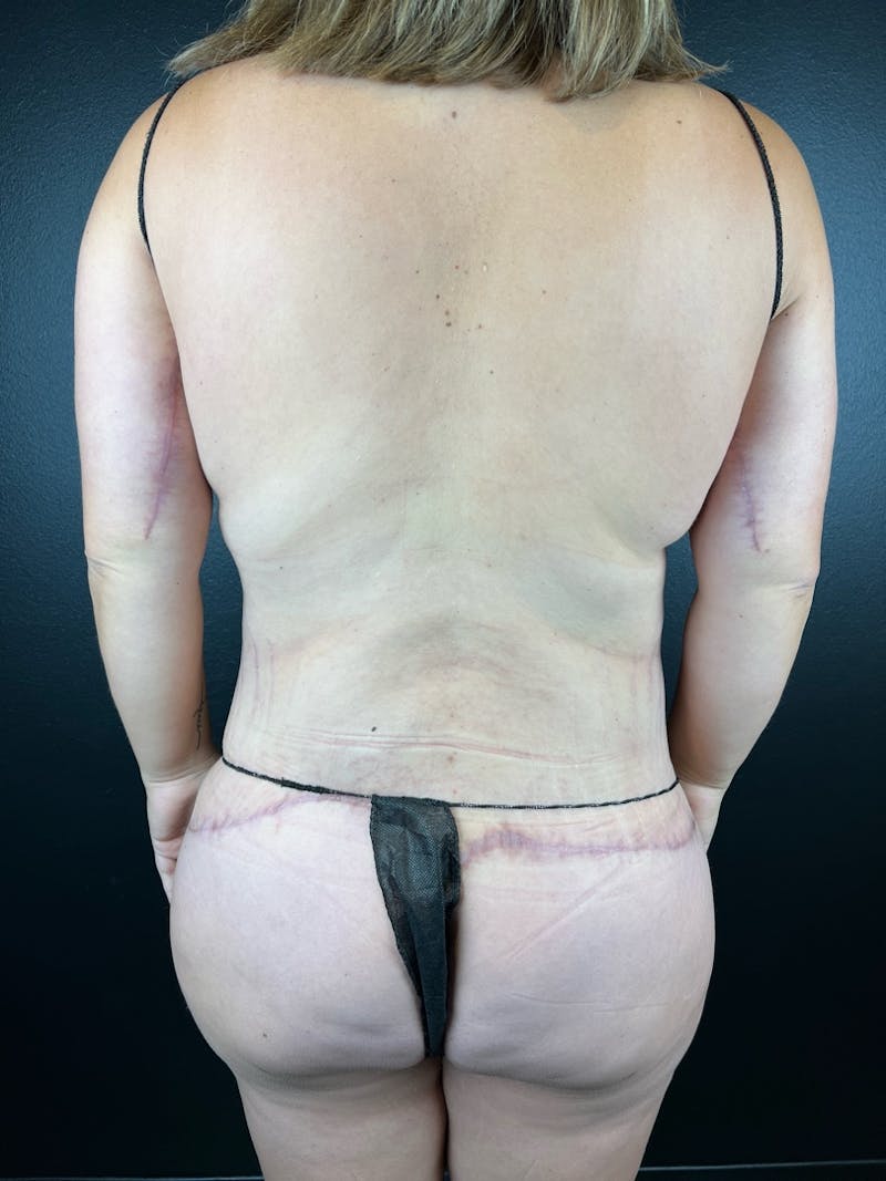 Lower Body Lift Before & After Gallery - Patient 227116 - Image 4