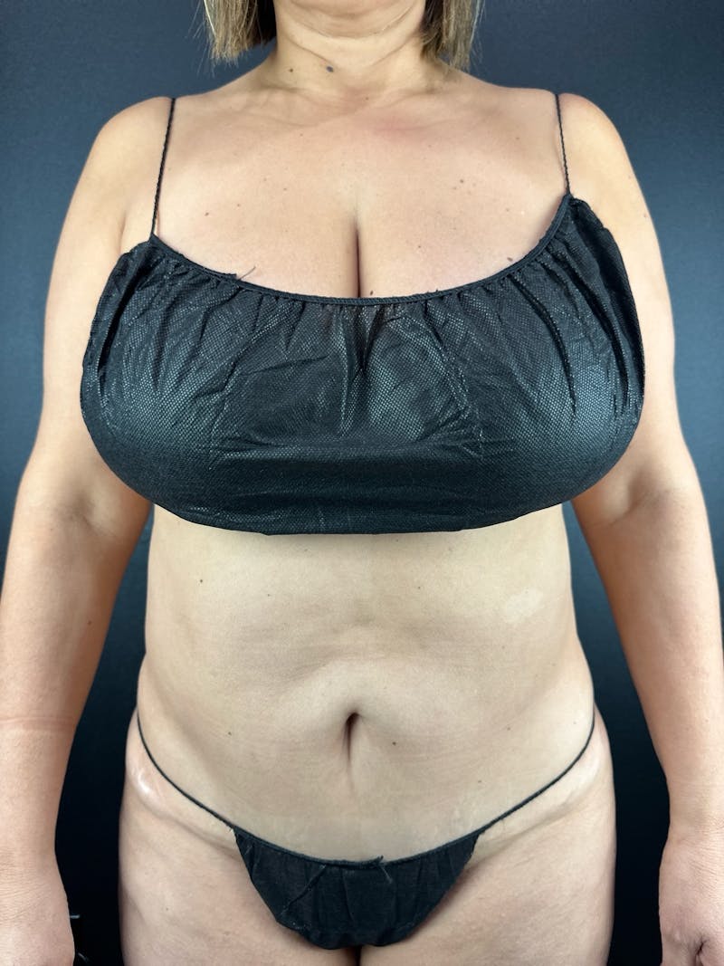 Tummy Tuck Before & After Gallery - Patient 259148 - Image 1