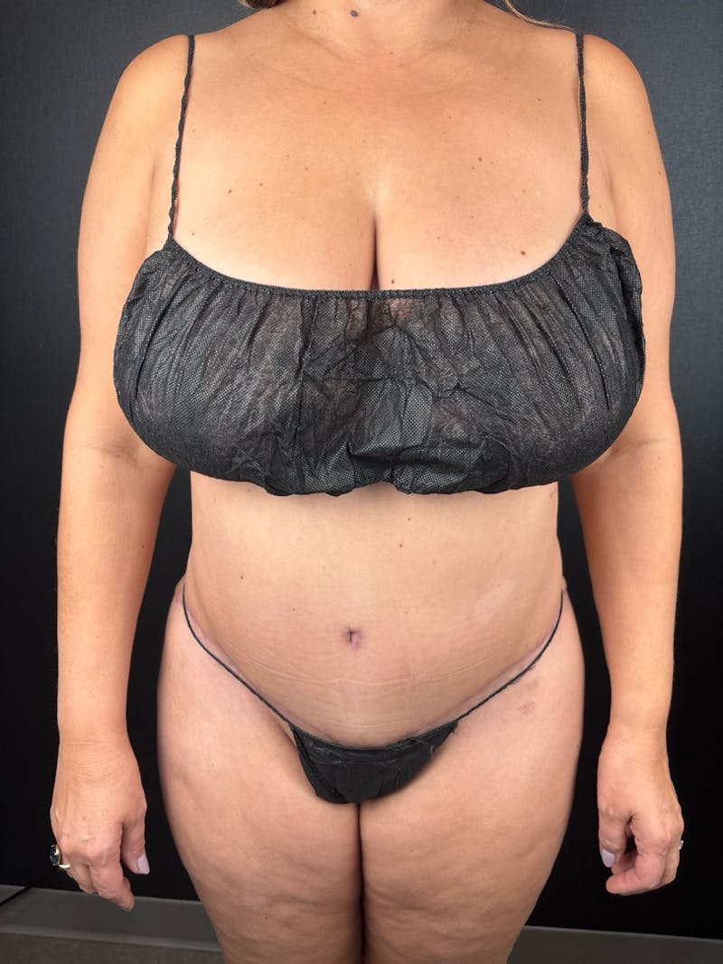 Tummy Tuck Before & After Gallery - Patient 259148 - Image 2