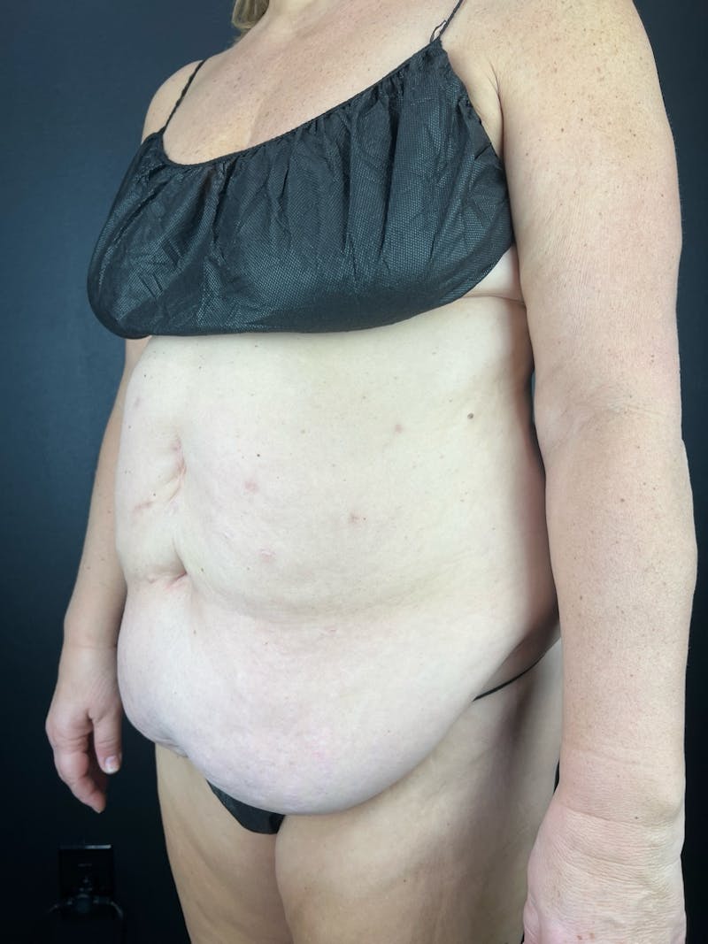 Tummy Tuck Before & After Gallery - Patient 153385 - Image 1