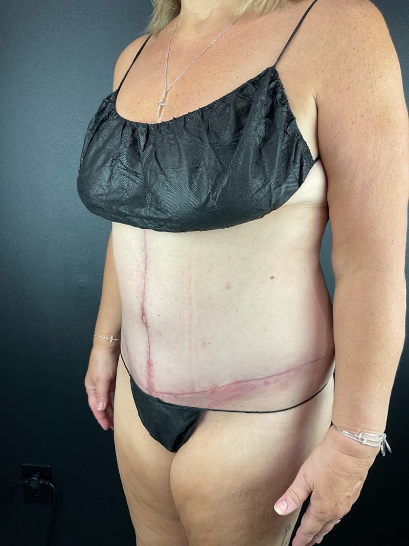 Tummy Tuck Before & After Gallery - Patient 153385 - Image 2
