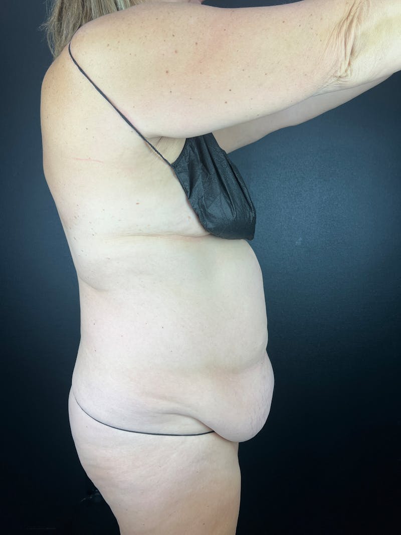 Tummy Tuck Before & After Gallery - Patient 153385 - Image 3