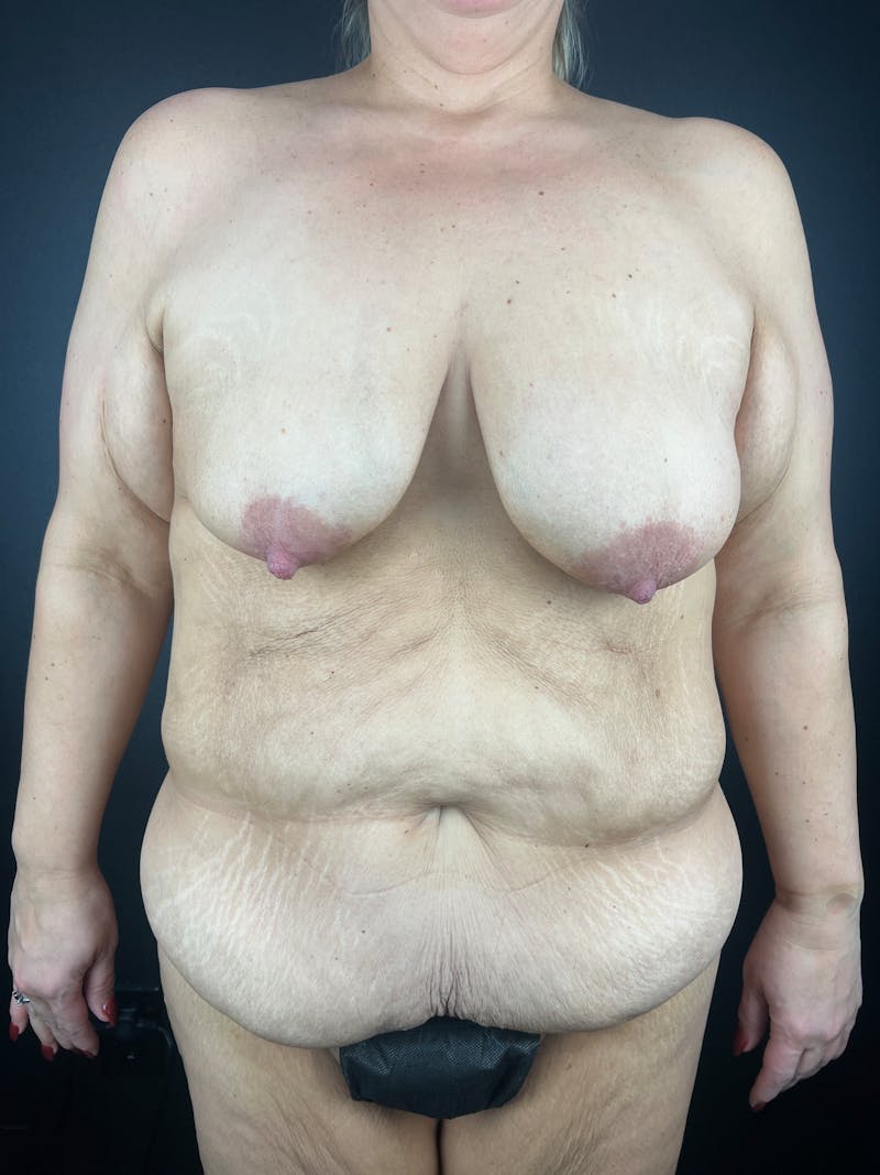 Tummy Tuck Before & After Gallery - Patient 113337 - Image 1
