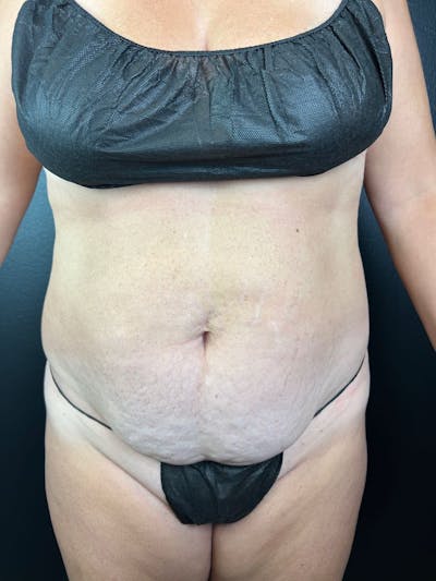 Tummy Tuck Before & After Gallery - Patient 428685 - Image 1