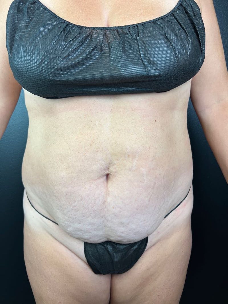 Tummy Tuck Before & After Gallery - Patient 428685 - Image 1