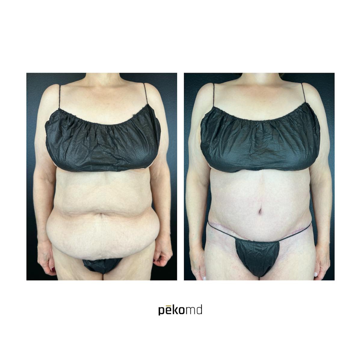 Tummy Tuck Before & After Gallery - Patient 353512 - Image 1
