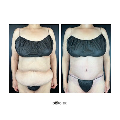 Tummy Tuck Before & After Gallery - Patient 353512 - Image 1