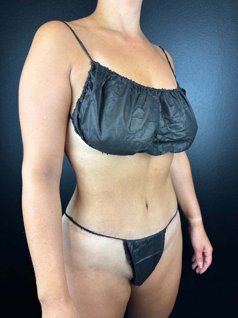 Tummy Tuck Before & After Gallery - Patient 412404 - Image 2