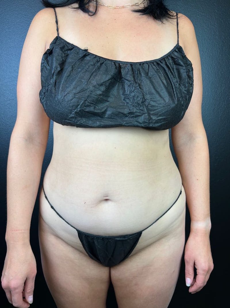 Tummy Tuck Before & After Gallery - Patient 412404 - Image 3