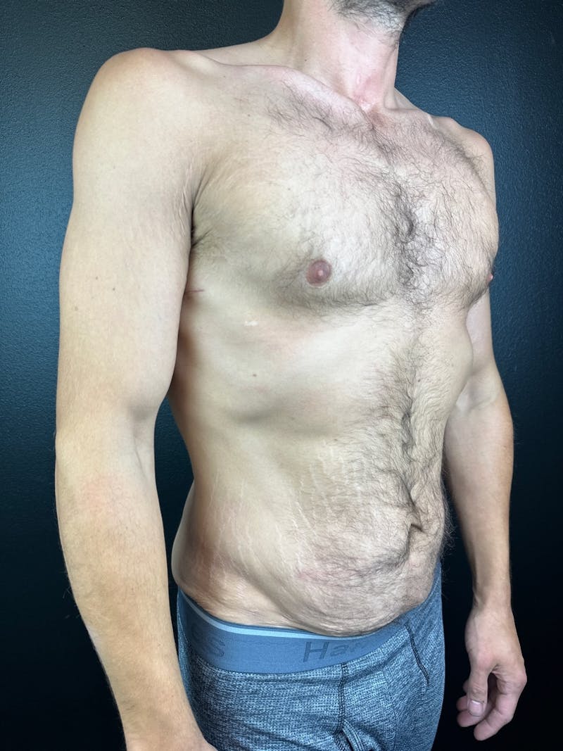 Tummy Tuck Before & After Gallery - Patient 854667 - Image 1