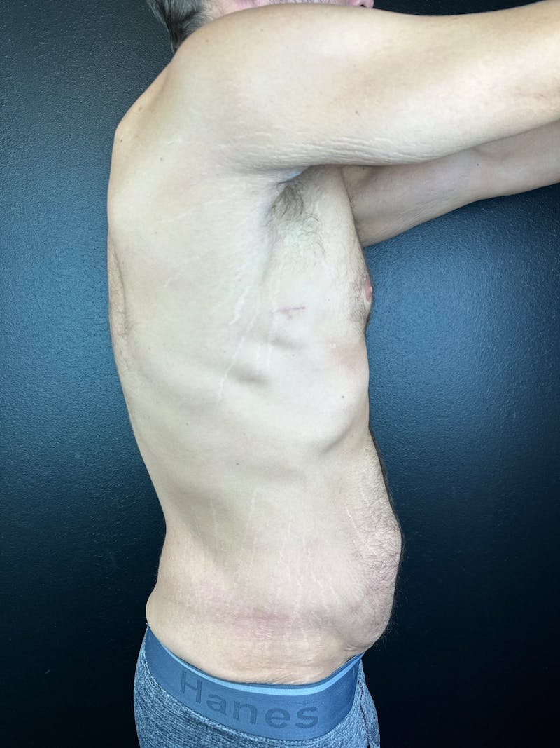 Tummy Tuck Before & After Gallery - Patient 854667 - Image 3