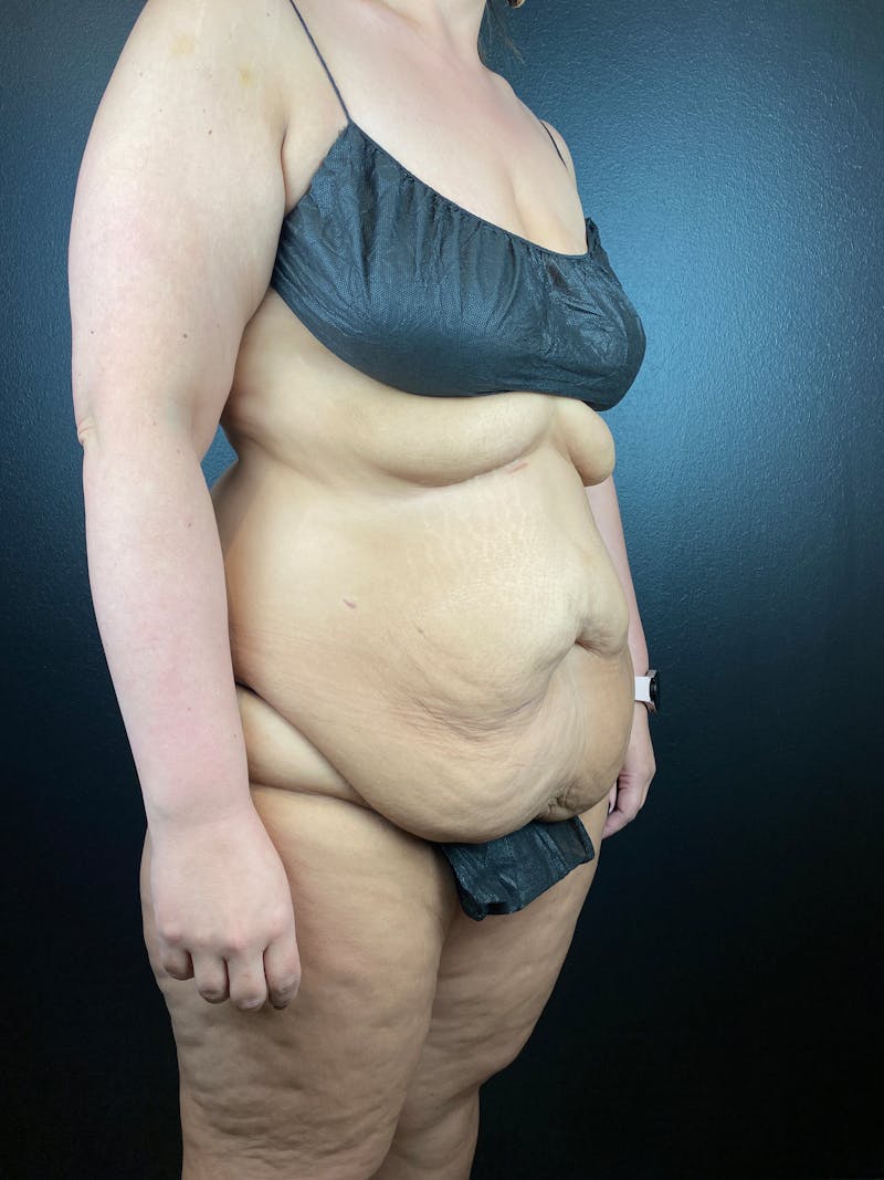 Tummy Tuck Before & After Gallery - Patient 300546 - Image 1