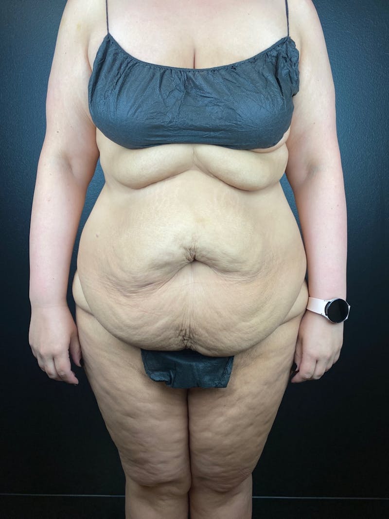 Tummy Tuck Before & After Gallery - Patient 300546 - Image 3