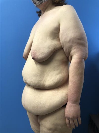 Tummy Tuck Before & After Gallery - Patient 645373 - Image 1