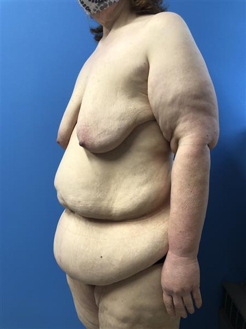 Tummy Tuck Before & After Gallery - Patient 645373 - Image 1