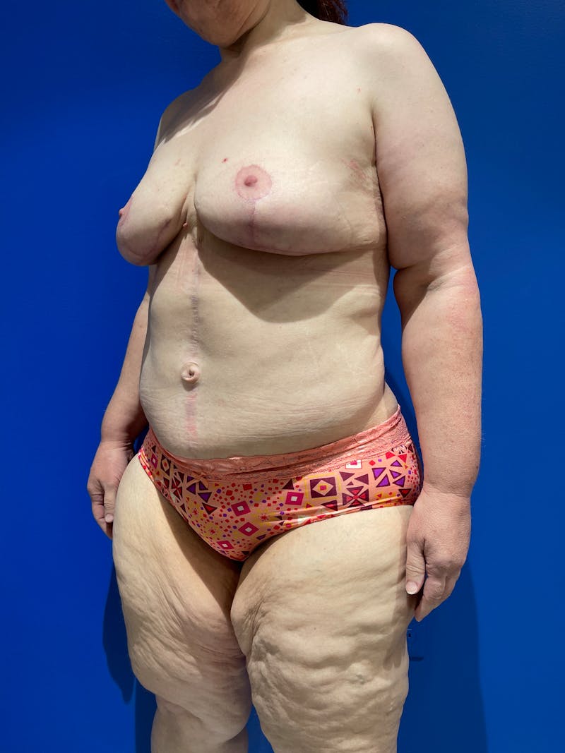 Tummy Tuck Before & After Gallery - Patient 645373 - Image 2