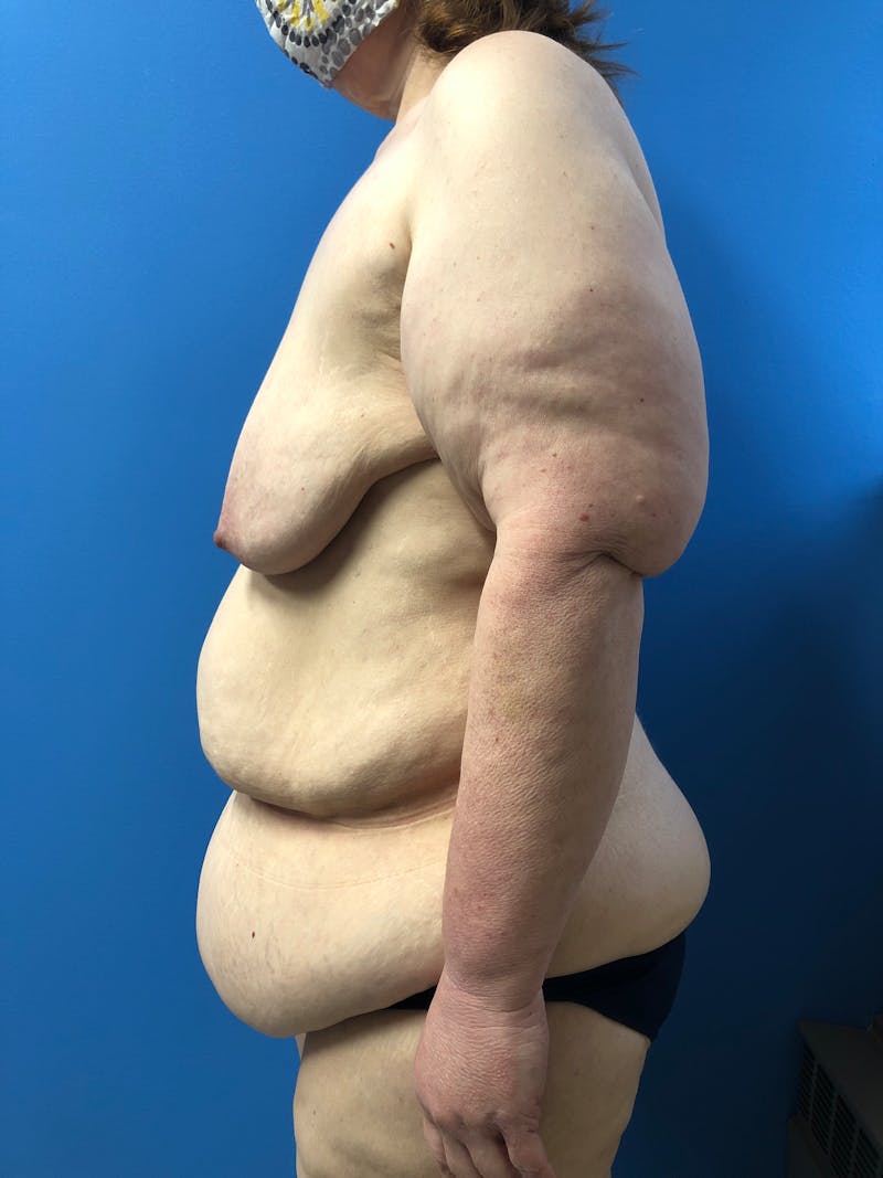Tummy Tuck Before & After Gallery - Patient 645373 - Image 3