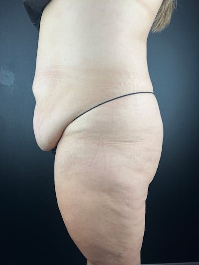 Tummy Tuck Before & After Gallery - Patient 106922 - Image 1