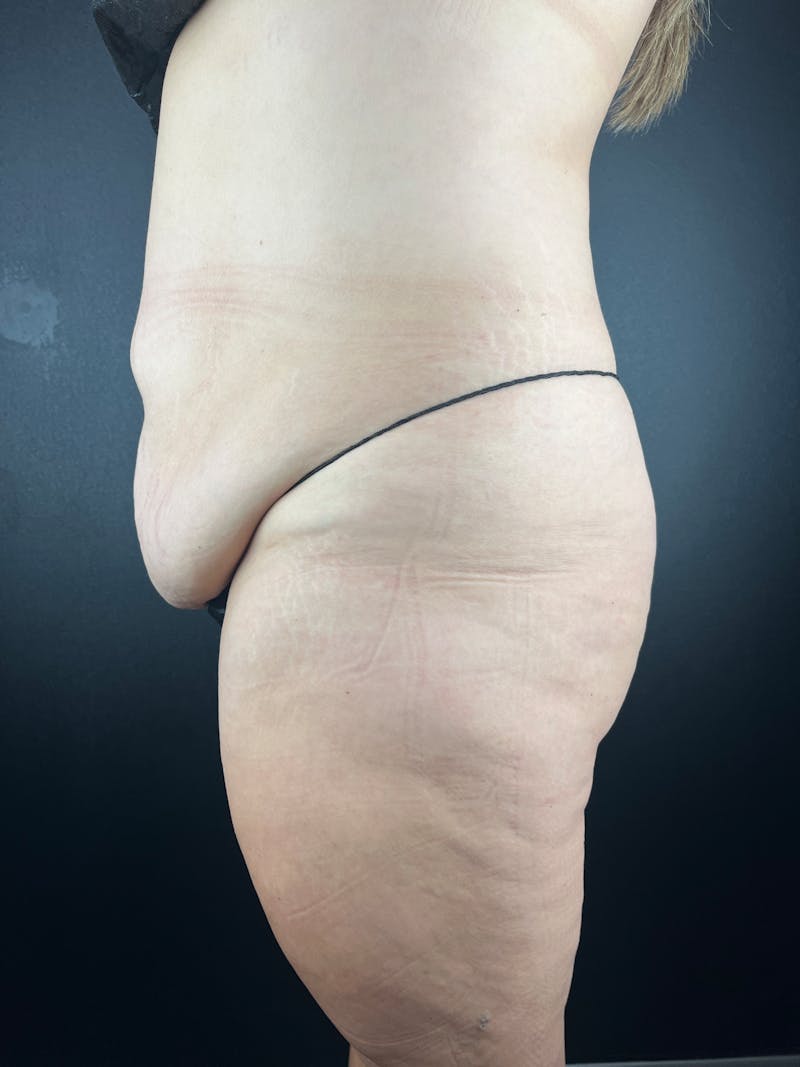 Tummy Tuck Before & After Gallery - Patient 106922 - Image 1