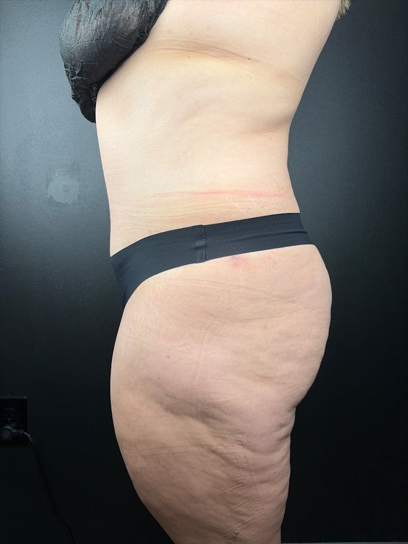 Tummy Tuck Before & After Gallery - Patient 106922 - Image 2