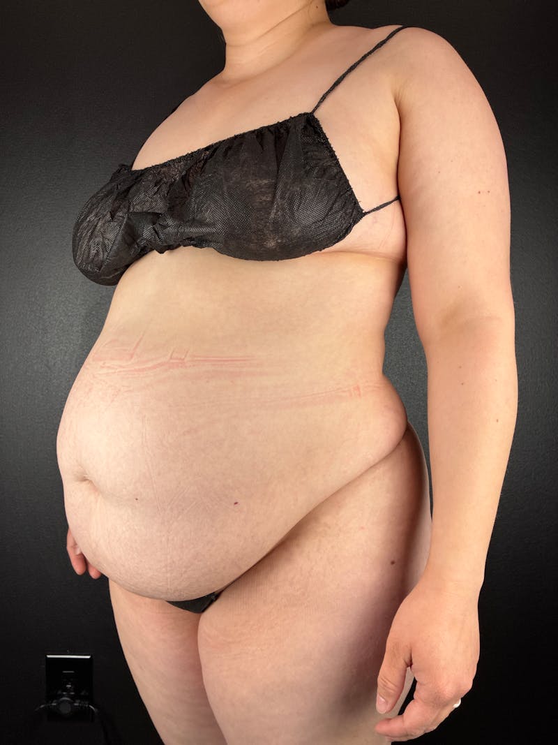 Tummy Tuck Before & After Gallery - Patient 955867 - Image 1