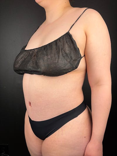Tummy Tuck Before & After Gallery - Patient 955867 - Image 2