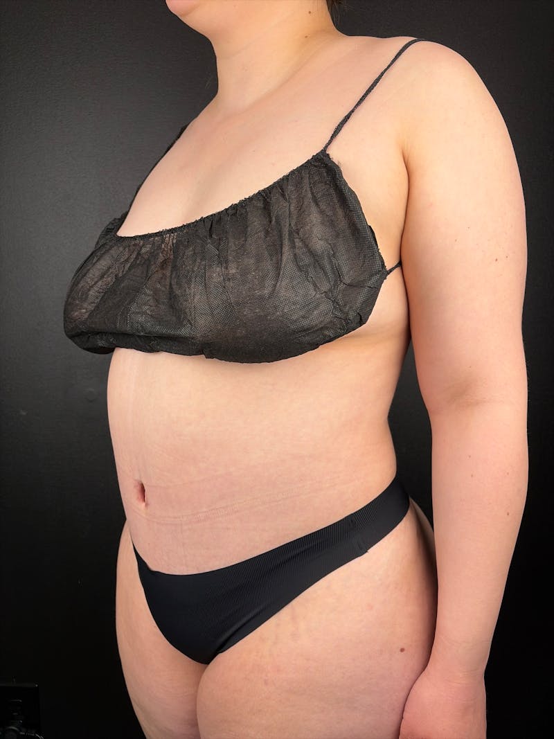 Tummy Tuck Before & After Gallery - Patient 955867 - Image 2