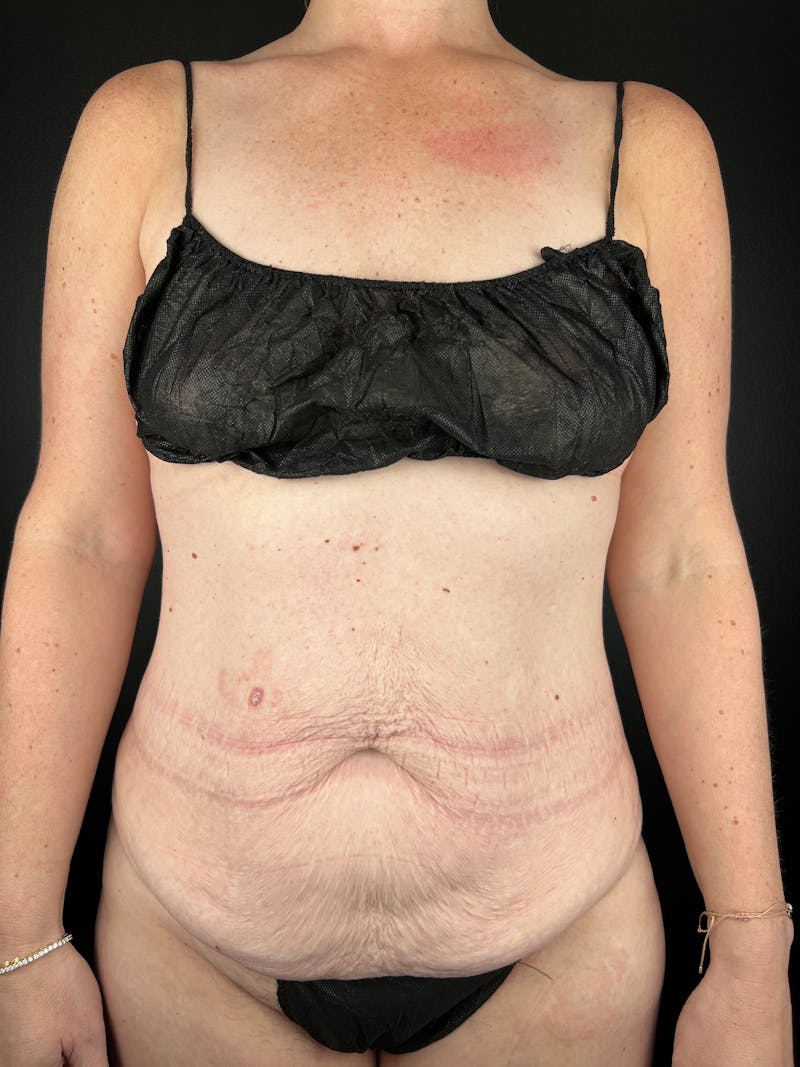 Tummy Tuck Before & After Gallery - Patient 232801 - Image 1