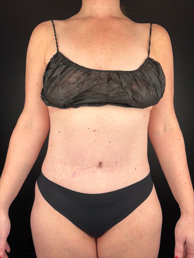 Tummy Tuck Before & After Gallery - Patient 232801 - Image 2