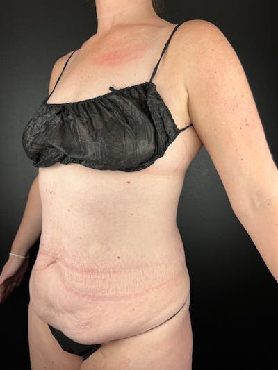 Tummy Tuck Before & After Gallery - Patient 193472 - Image 1
