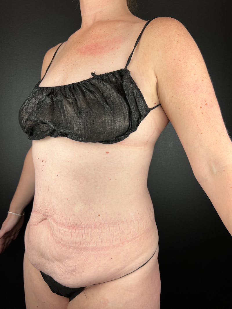 Tummy Tuck Before & After Gallery - Patient 193472 - Image 1