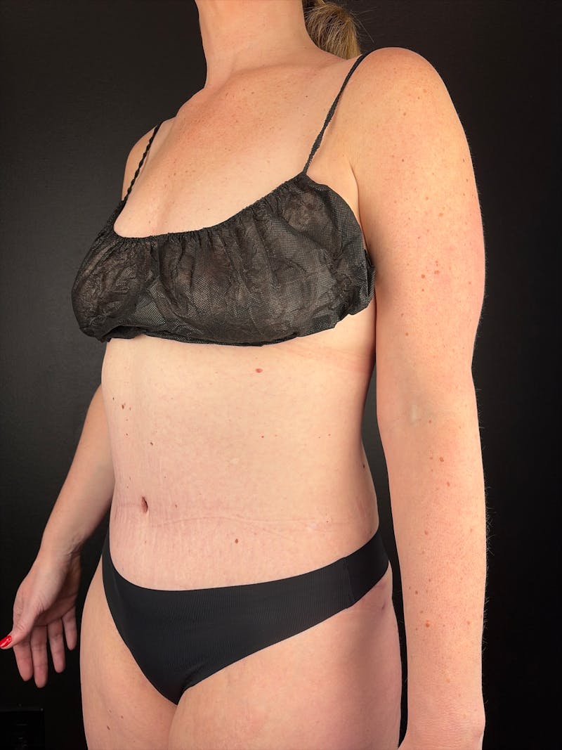 Tummy Tuck Before & After Gallery - Patient 193472 - Image 2