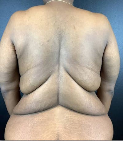 Upper Back Lift Before & After Gallery - Patient 775051 - Image 1