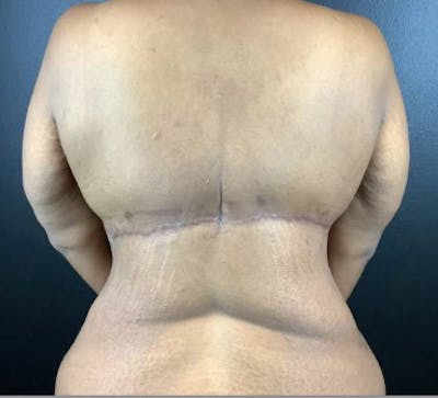 Upper Back Lift Before & After Gallery - Patient 775051 - Image 2
