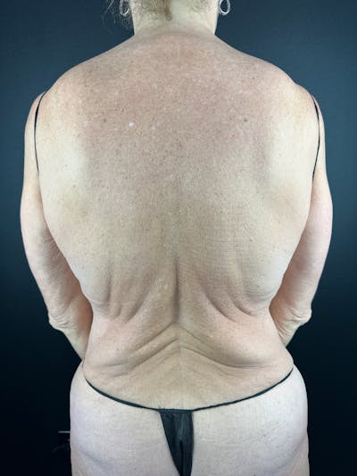 Upper Back Lift Before & After Gallery - Patient 900641 - Image 1