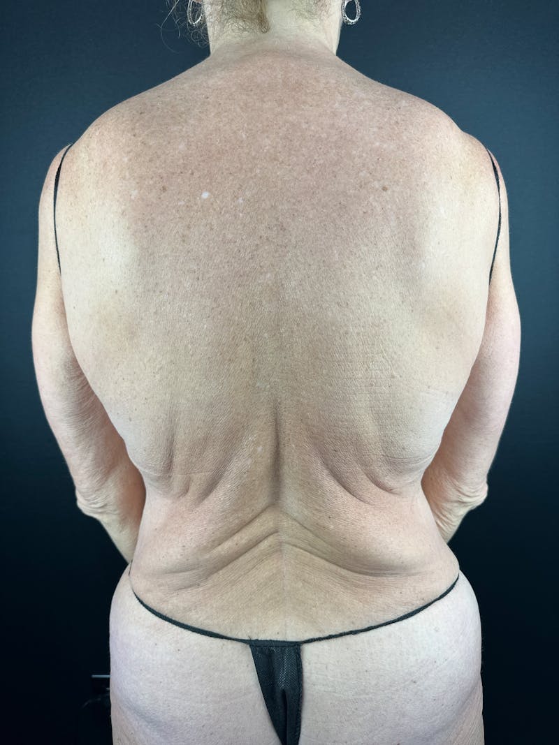 Upper Back Lift Before & After Gallery - Patient 900641 - Image 1