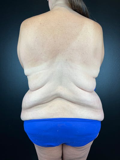 Upper Back Lift Before & After Gallery - Patient 358029 - Image 1