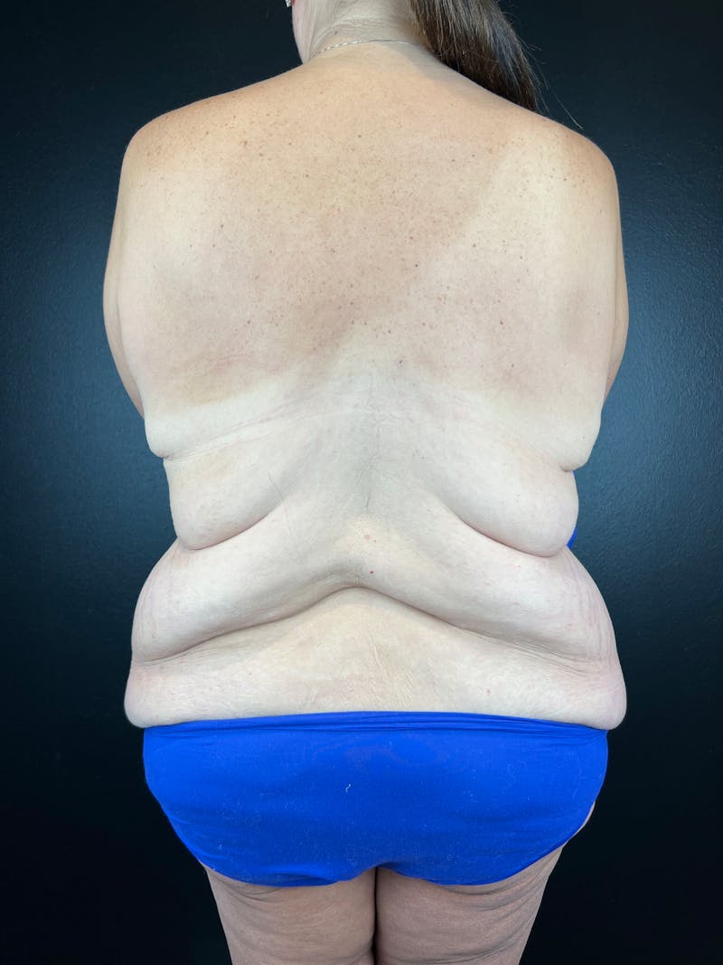 Upper Back Lift Before & After Gallery - Patient 358029 - Image 1