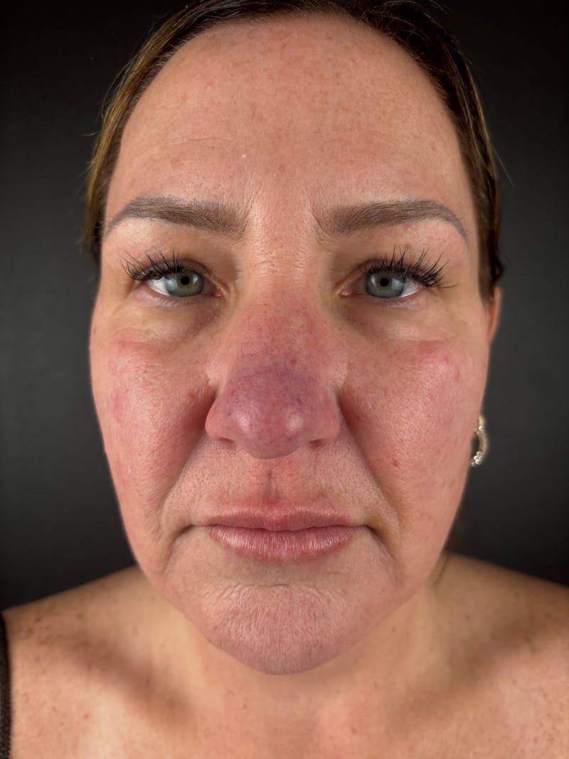 Blepharoplasty Before & After Gallery - Patient 424961 - Image 2