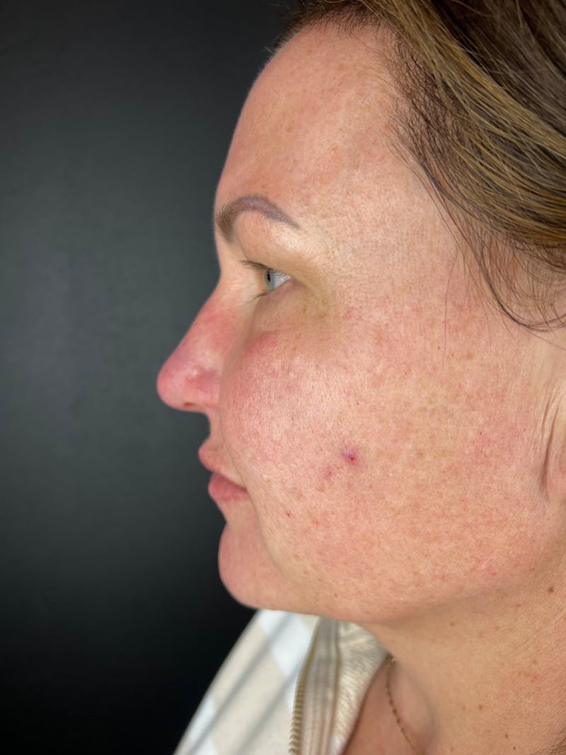 Blepharoplasty Before & After Gallery - Patient 424961 - Image 3