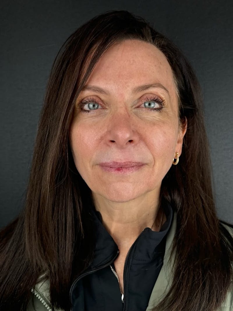 Blepharoplasty Before & After Gallery - Patient 350183 - Image 4