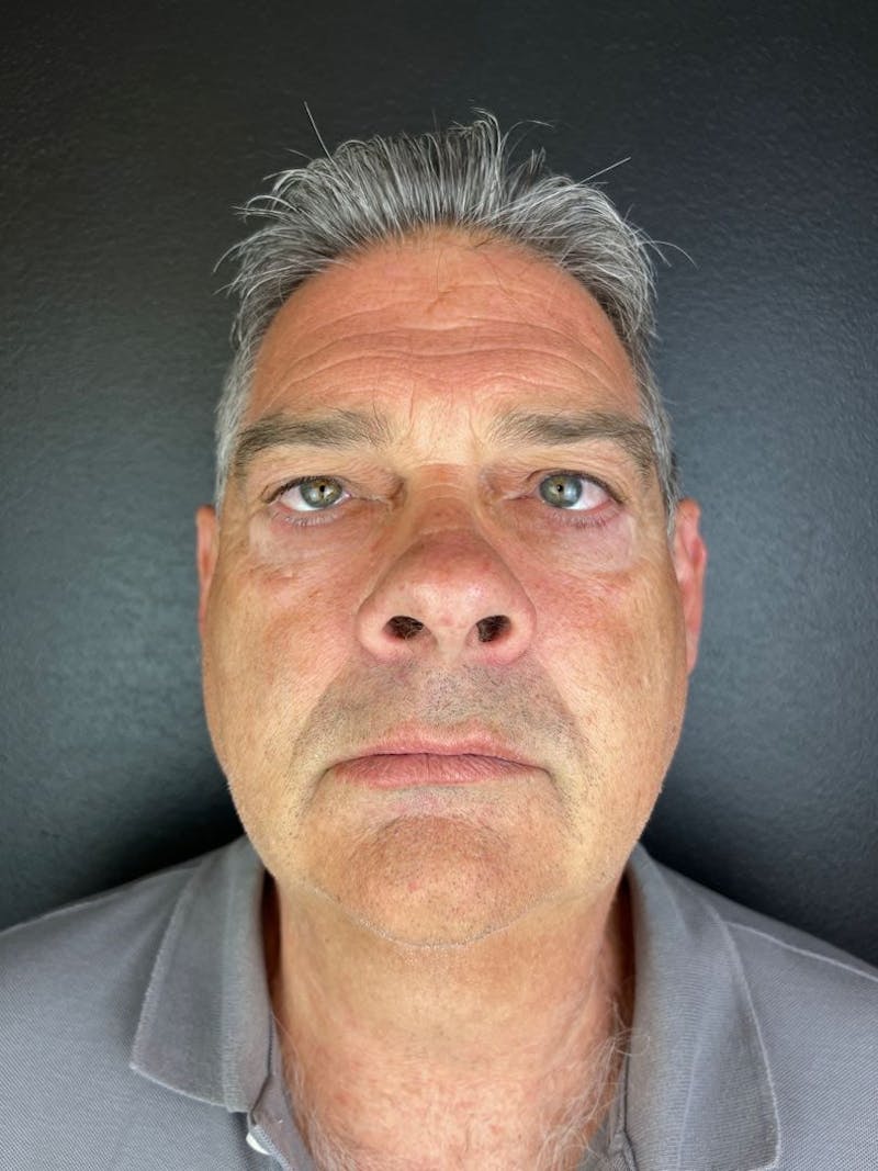 Blepharoplasty Before & After Gallery - Patient 152267 - Image 2