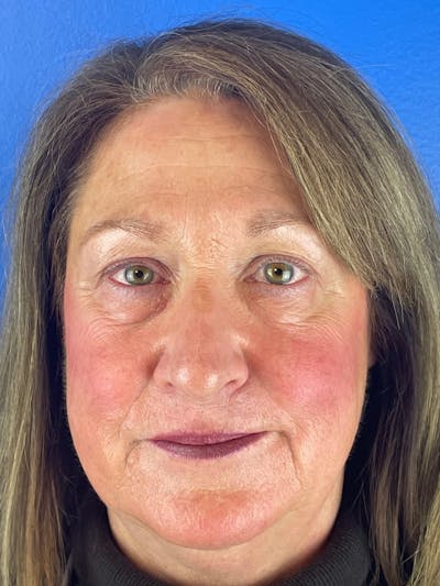 Blepharoplasty Before & After Gallery - Patient 366682 - Image 1