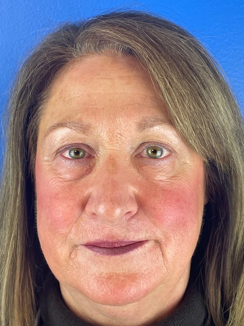 Blepharoplasty Before & After Gallery - Patient 366682 - Image 1