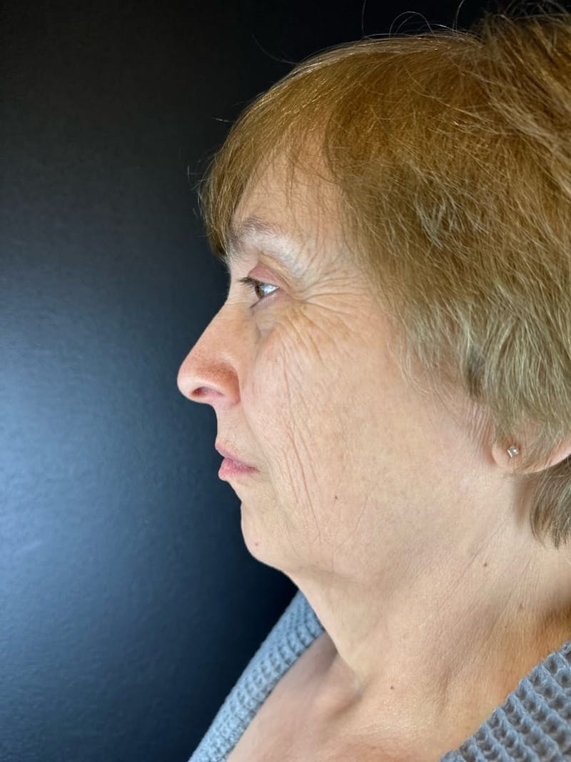 Facelift Before & After Gallery - Patient 679849 - Image 3
