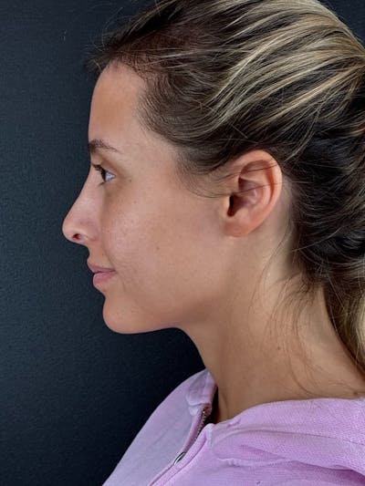 Hairline Advancement Before & After Gallery - Patient 115833 - Image 2
