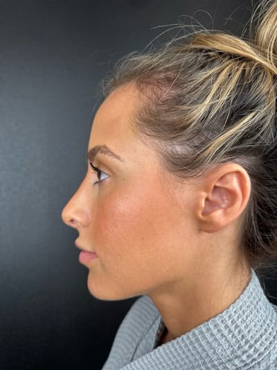 Hairline Advancement Before & After Gallery - Patient 115833 - Image 1
