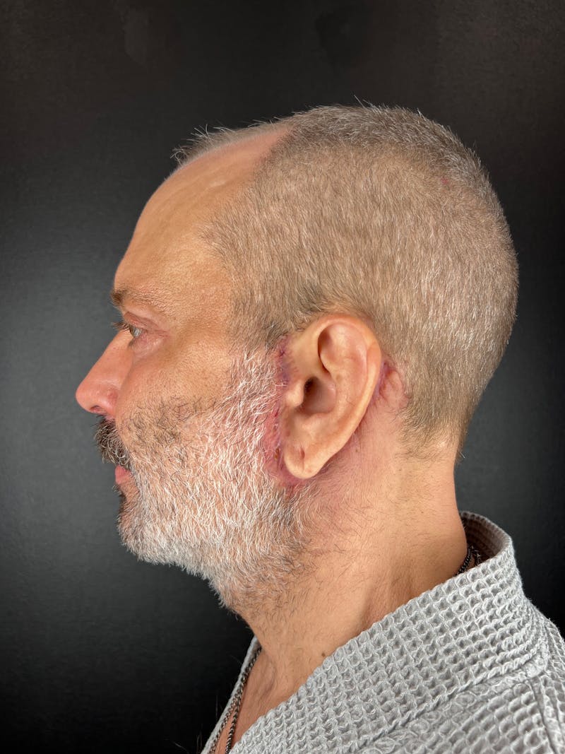 Neck Lift Before & After Gallery - Patient 300097 - Image 2