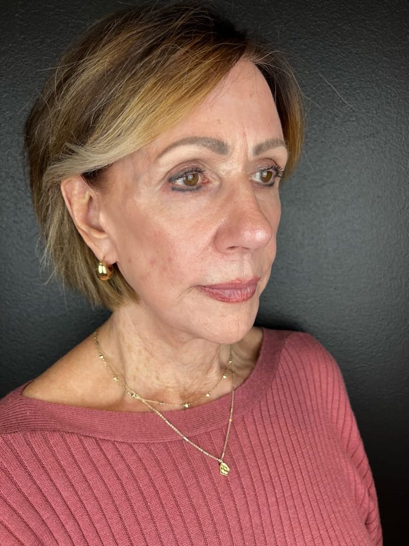 Neck Lift Before & After Gallery - Patient 291179 - Image 2