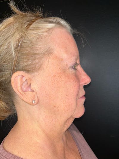 Neck Lift Before & After Gallery - Patient 248506 - Image 1